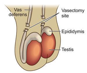 Image result for vasectomy