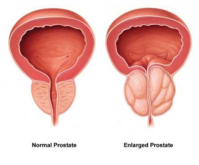 transuretral resection prostat)