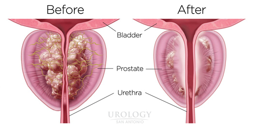 Normal range of prostate.