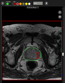 Prostate Biopsy San Antonio