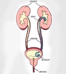 icd 10 code for stent placement ureteral
