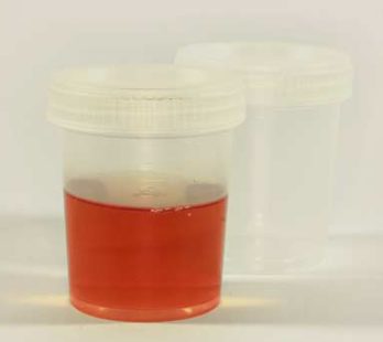 Blood in Urine - Hematuria