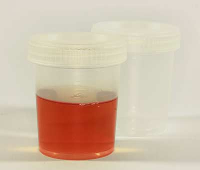 Blood in Urine - Hematuria