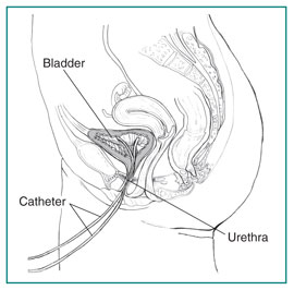 Urodynamics Testing - Bladder Testing, Preparation, and Follow-Up