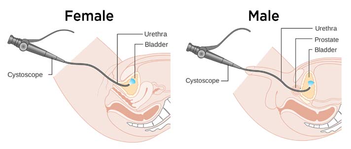 Urethra Urethral Sounding: