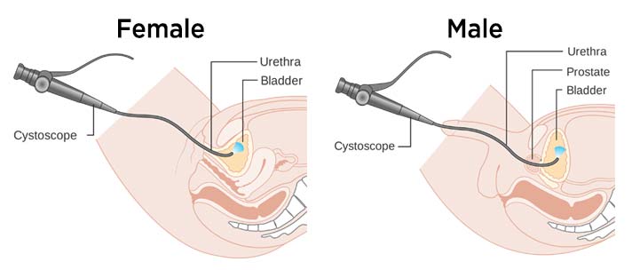 Cystoscopy Procedure