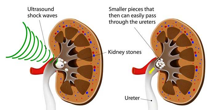 Prostatitis lithotripsy