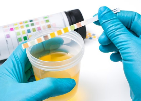 Urinalysis - Test Strips